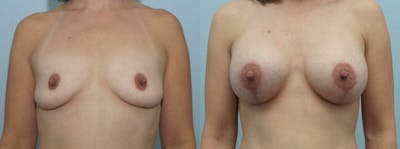 Breast Lift With Implants Before & After Gallery - Patient 48813702 - Image 1