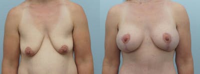 Breast Lift With Implants Before & After Gallery - Patient 48813711 - Image 1