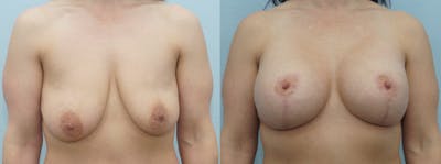 Breast Lift With Implants Before & After Gallery - Patient 48813721 - Image 1