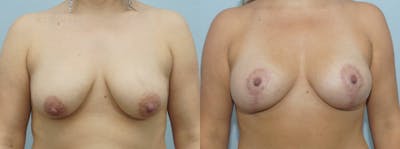Breast Lift With Implants Before & After Gallery - Patient 48813728 - Image 1
