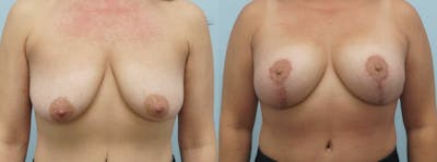 Breast Lift With Implants Before & After Gallery - Patient 48813750 - Image 1