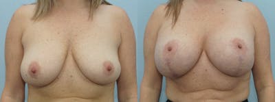 Breast Lift With Implants Before & After Gallery - Patient 48813792 - Image 1