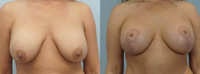 Breast Lift With Implants Before & After Gallery - Patient 48813837 - Image 1