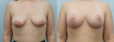 Breast Lift With Implants Before & After Gallery - Patient 48813868 - Image 1