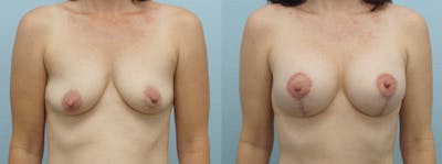 Breast Lift With Implants Before & After Gallery - Patient 48813912 - Image 1