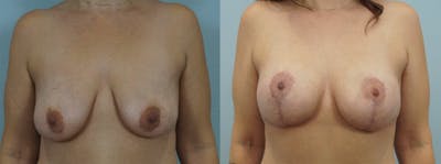 Breast Lift With Implants Before & After Gallery - Patient 48813938 - Image 1