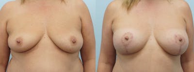 Breast Lift With Implants Before & After Gallery - Patient 48813946 - Image 1