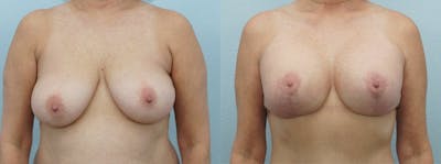 Breast Lift With Implants Before & After Gallery - Patient 48813952 - Image 1