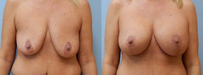 Breast Lift With Implants Before & After Gallery - Patient 48813958 - Image 1