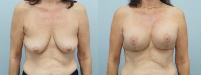 Breast Lift With Implants Before & After Gallery - Patient 48813965 - Image 1