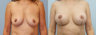 Breast Lift With Implants Before & After Gallery - Patient 48813970 - Image 1