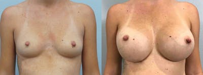 Breast Augmentation Before & After Gallery - Patient 48813985 - Image 1