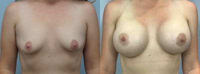 Breast Augmentation Before & After Gallery - Patient 48813990 - Image 1