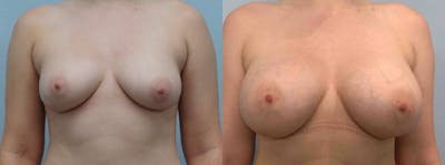 Breast Augmentation Before & After Gallery - Patient 48813996 - Image 1