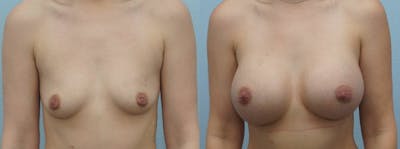 Breast Augmentation Before & After Gallery - Patient 48814012 - Image 1
