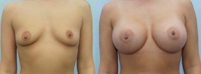 Breast Augmentation Before & After Gallery - Patient 48814018 - Image 1
