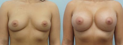 Breast Augmentation Before & After Gallery - Patient 48814024 - Image 1