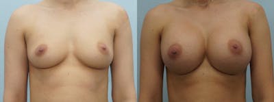 Breast Augmentation Before & After Gallery - Patient 48814034 - Image 1