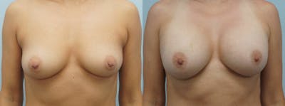Breast Augmentation Before & After Gallery - Patient 48814040 - Image 1