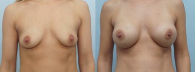 Breast Augmentation Before & After Gallery - Patient 48814046 - Image 1
