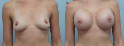Breast Augmentation Before & After Gallery - Patient 48814053 - Image 1