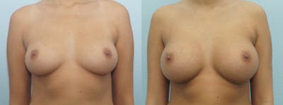 Breast Augmentation Before & After Gallery - Patient 48814060 - Image 1