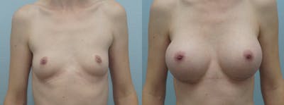 Breast Augmentation Before & After Gallery - Patient 48814065 - Image 1