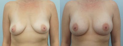 Breast Augmentation Before & After Gallery - Patient 48814073 - Image 1