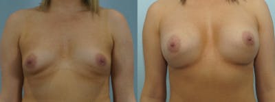 Breast Augmentation Before & After Gallery - Patient 48814079 - Image 1