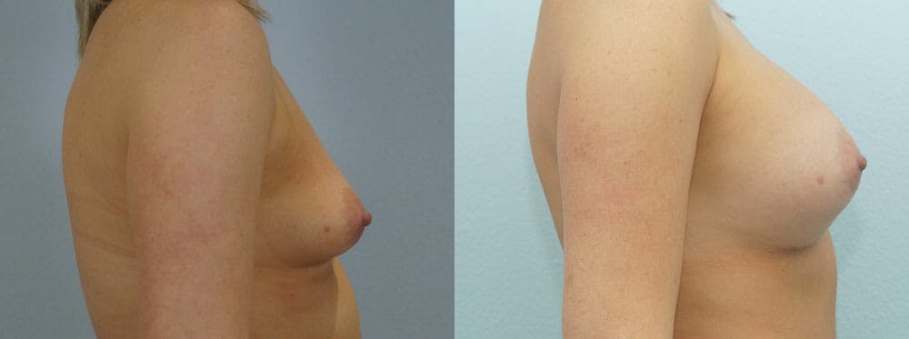 Breast Augmentation Gallery - Patient 48814079 - Image 3