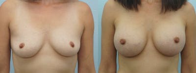 Breast Augmentation Before & After Gallery - Patient 48814086 - Image 1
