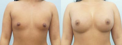 Breast Augmentation Before & After Gallery - Patient 48814095 - Image 1