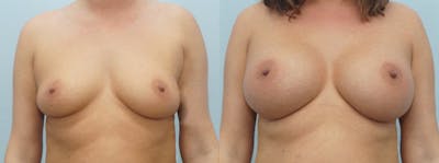 Breast Augmentation Before & After Gallery - Patient 48814101 - Image 1