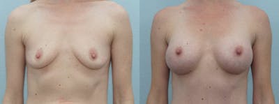 Breast Augmentation Before & After Gallery - Patient 48814113 - Image 1