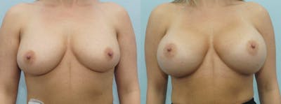 Breast Augmentation Before & After Gallery - Patient 48814122 - Image 1