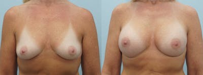Breast Augmentation Before & After Gallery - Patient 48814127 - Image 1