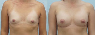 Breast Augmentation Before & After Gallery - Patient 48814135 - Image 1