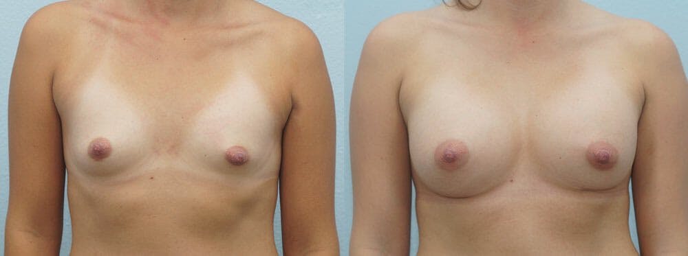 Breast Augmentation Gallery - Patient 48814135 - Image 1