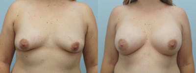 Breast Augmentation Before & After Gallery - Patient 48814139 - Image 1