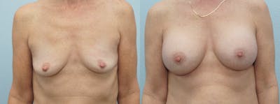 Breast Augmentation Before & After Gallery - Patient 48814141 - Image 1