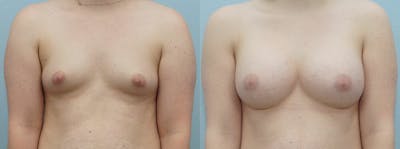 Breast Augmentation Before & After Gallery - Patient 48814147 - Image 1