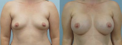 Breast Augmentation Before & After Gallery - Patient 48814150 - Image 1