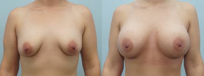 Breast Augmentation Before & After Gallery - Patient 48814151 - Image 1