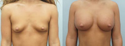 Breast Augmentation Before & After Gallery - Patient 48814154 - Image 1
