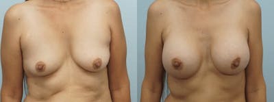 Breast Augmentation Before & After Gallery - Patient 48814155 - Image 1