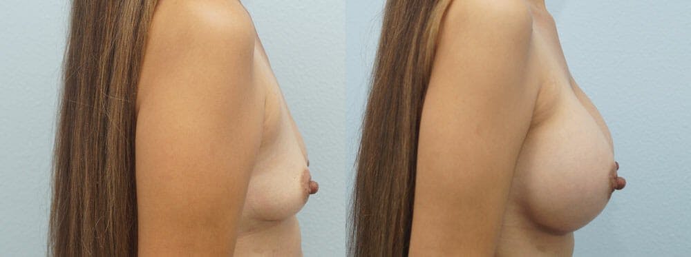 Breast Augmentation Gallery - Patient 48814155 - Image 5