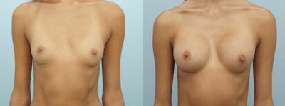 Breast Augmentation Before & After Gallery - Patient 48814157 - Image 1