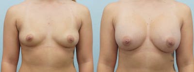 Breast Augmentation Before & After Gallery - Patient 48821278 - Image 1
