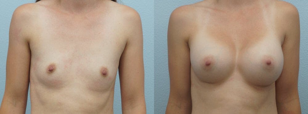Breast Augmentation Gallery - Patient 48821283 - Image 1