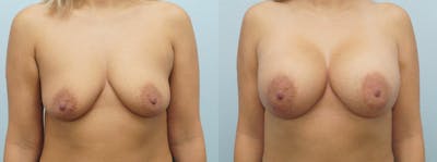 Breast Augmentation Before & After Gallery - Patient 48821288 - Image 1